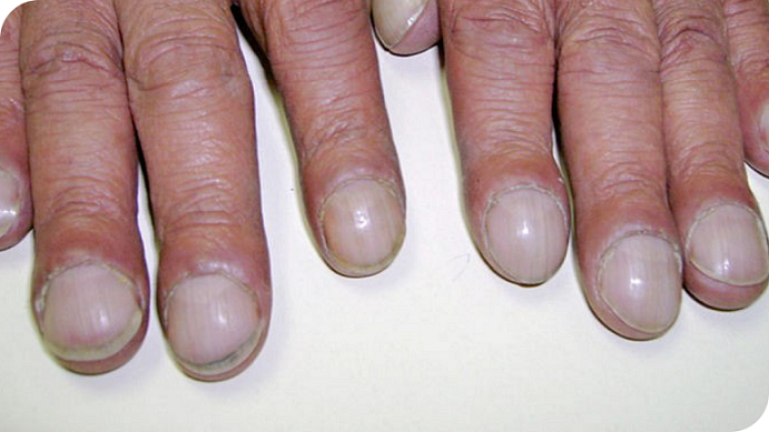 Onderliggende auto immuunaandoeningenreumatische aandoeningen